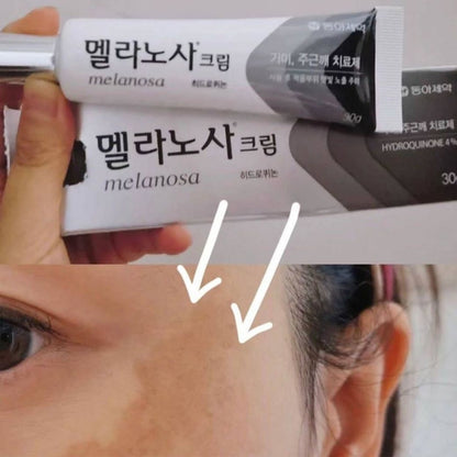 Dong-A Melanosa 30g for Excessive melanin pigmentation (spots, freckles, dark spots, age spots, senile spots)